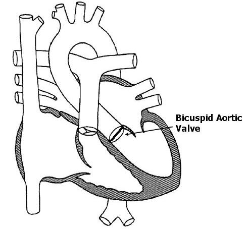 Bicuspid Aortic Valve
